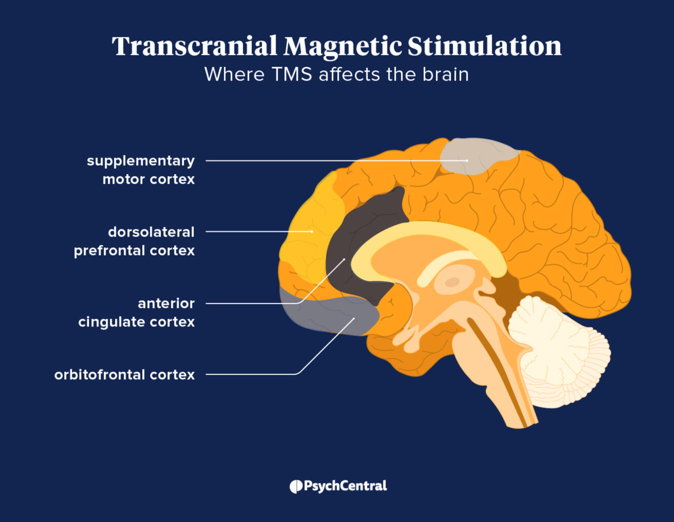TMS Infographic Infographic of how TMS affects the brain.