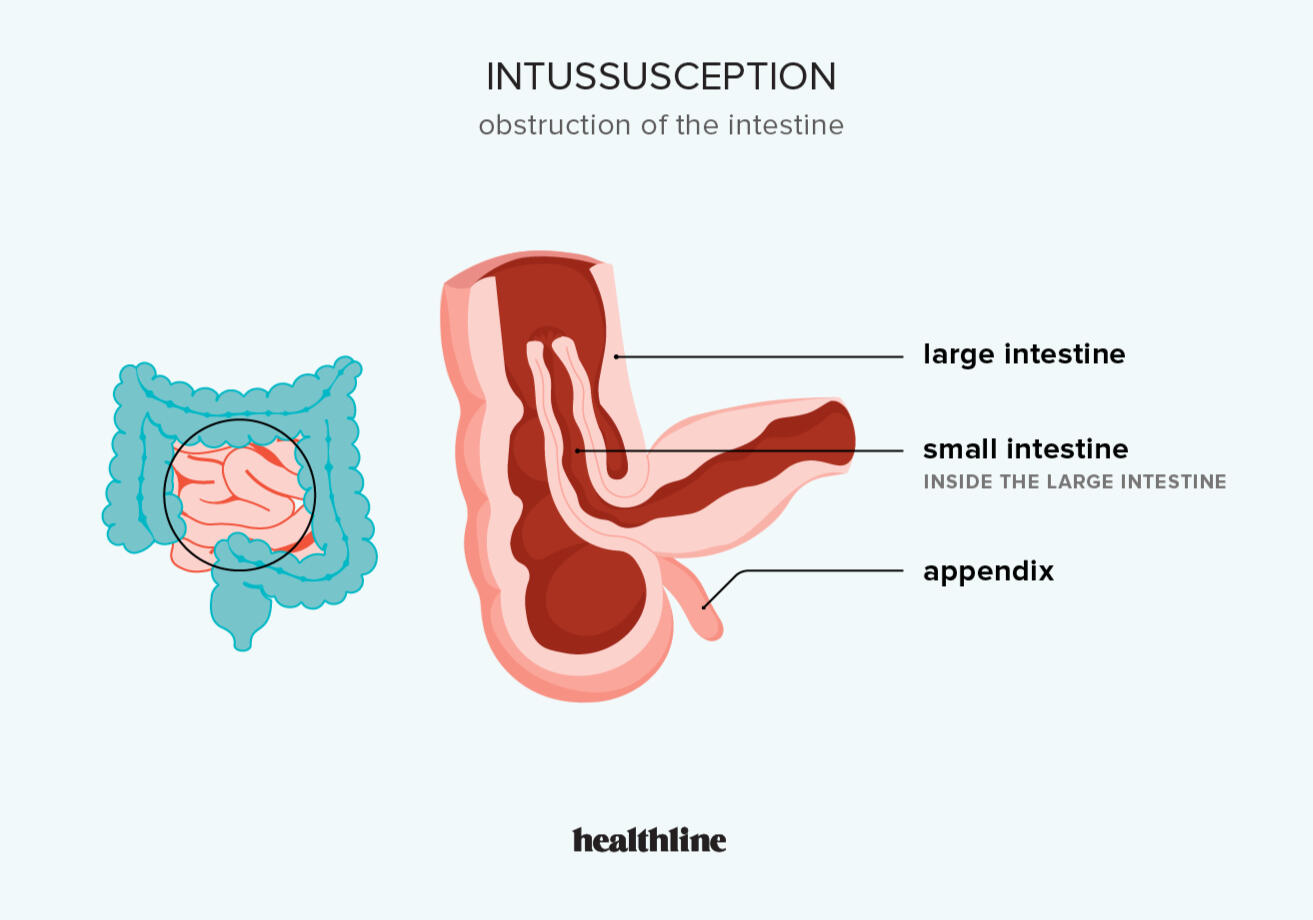 Intussusception Infographic Infographic of intestinal obstruction.