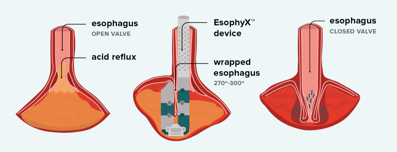 TIF Nonsurgical Procedure Infographic of acid reflux relief.