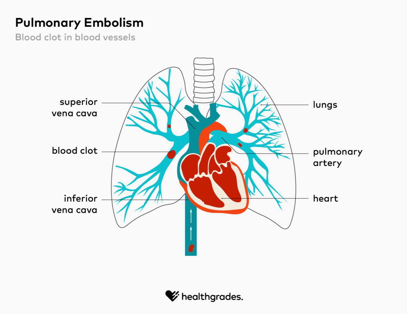 Pulmonary Embolism Infographic of blood clots in the lungs.